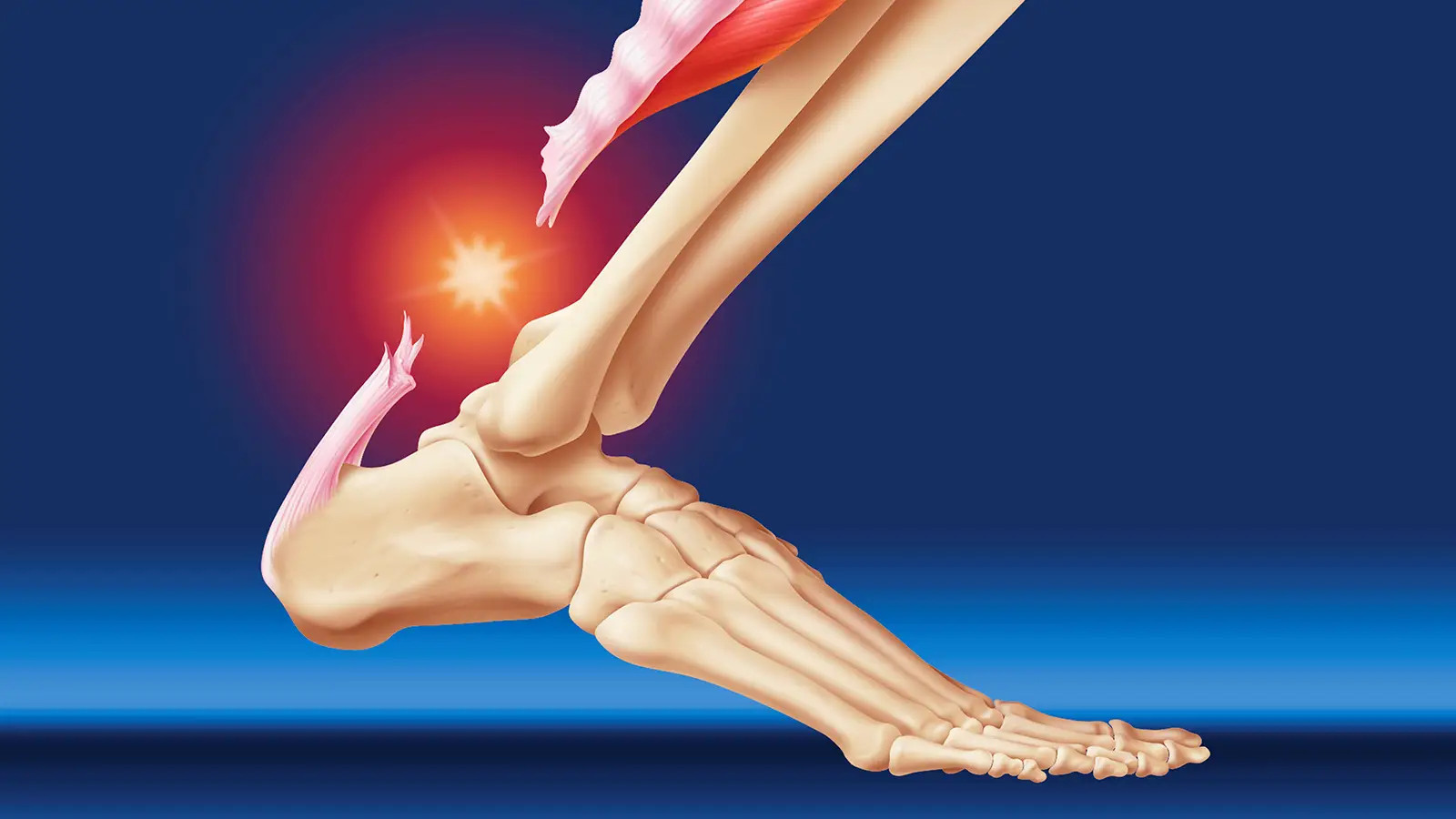 Cedera Tendon